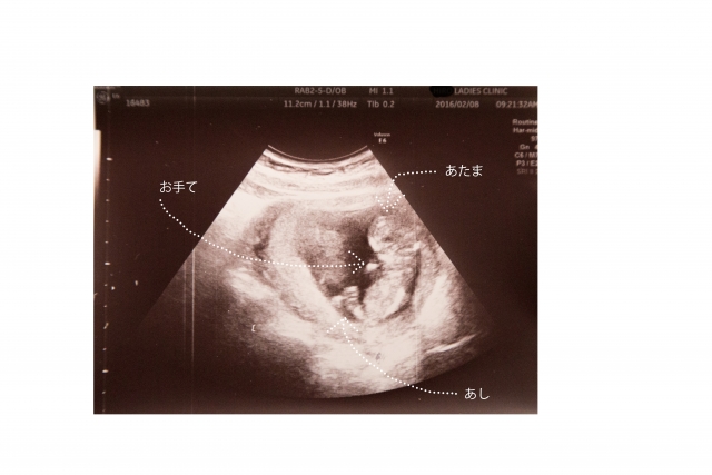 双子　妊娠初期